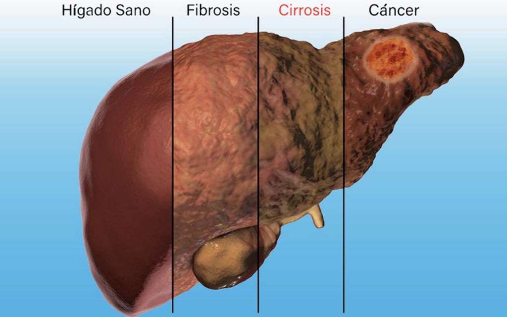 cirrosis del higado vs higado sano